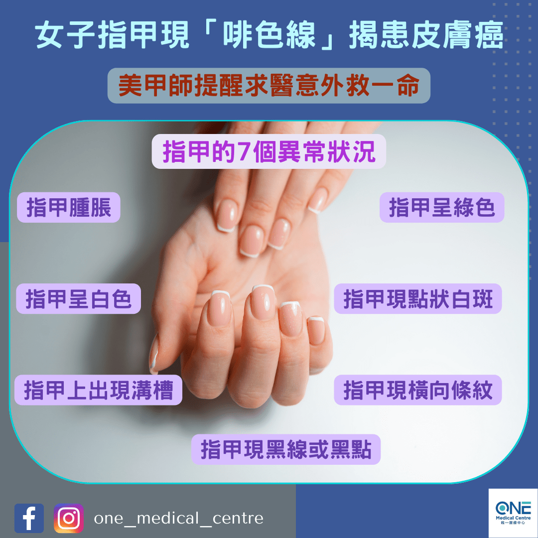 【黑色素瘤 – 女子指甲現「啡色線」揭患皮膚癌　美甲師提醒求醫意外救一命】